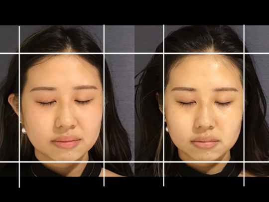 丸顔が気になる女性を小顔矯正〈before＆after/顔解説