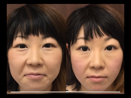 30　女　顔 エラが気になる30代女性を小顔矯正〈before＆after/顔解説〉 - ゆうき式小顔矯正